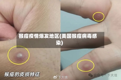 猴痘疫情爆发地区(美国猴痘病毒感染)-第3张图片